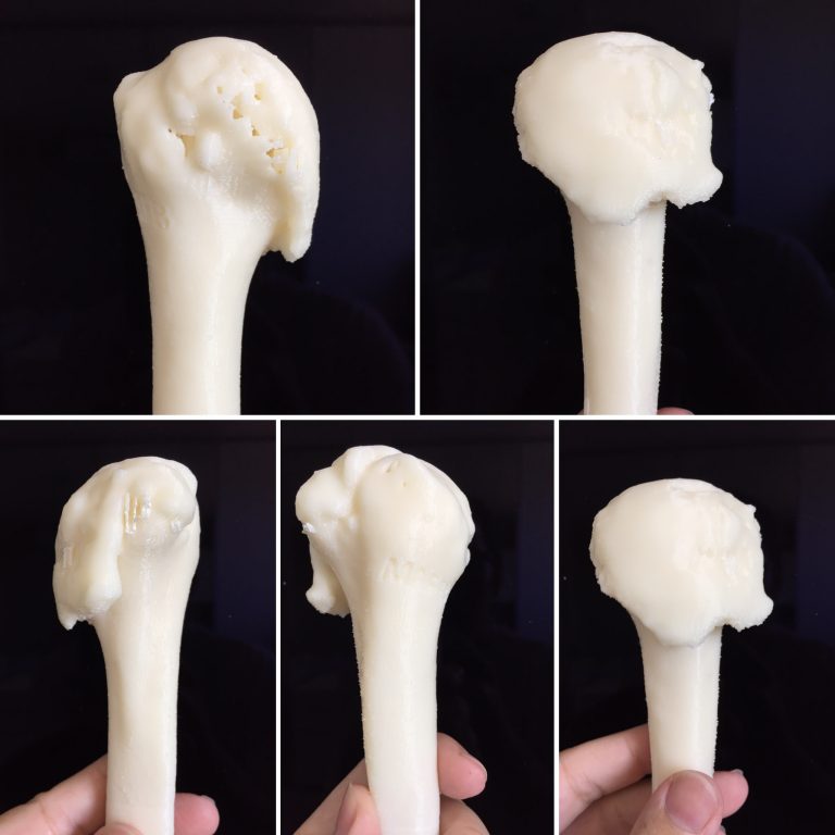 Uso prático da impressão 3d na medicina